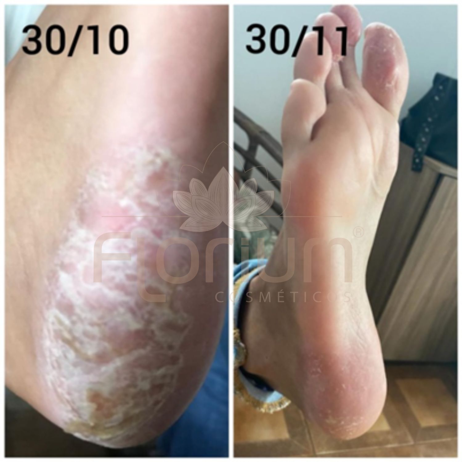Resultados Creme dos pés (3)